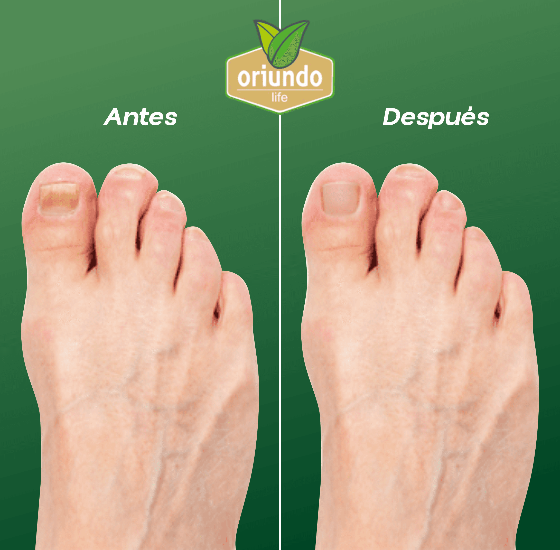 Antes y Después del tratamiento con Oriundo Life