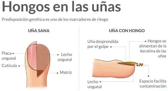 Infografía: Uña sana vs uña con hongo - cómo atacan los hongos